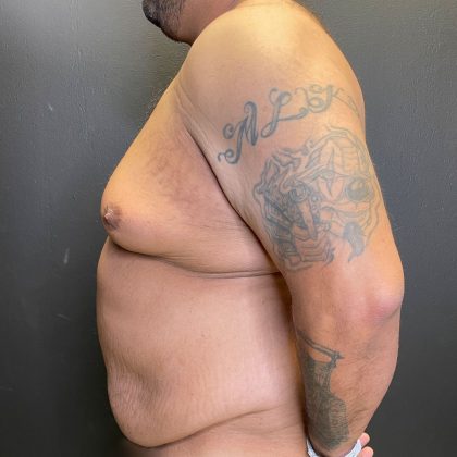 Gynecomastia Before & After Patient #4710