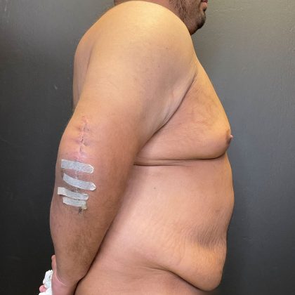 Gynecomastia Before & After Patient #4710