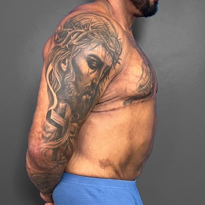 Gynecomastia Before & After Patient #4710