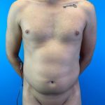 Liposuction Before & After Patient #4721