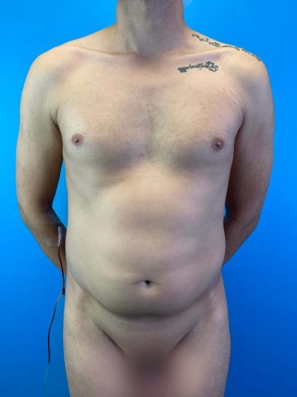 Liposuction Before & After Patient #4721