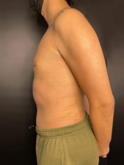 Liposuction Before & After Patient #4721