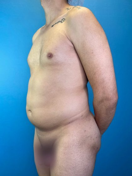 Liposuction Before & After Patient #4721