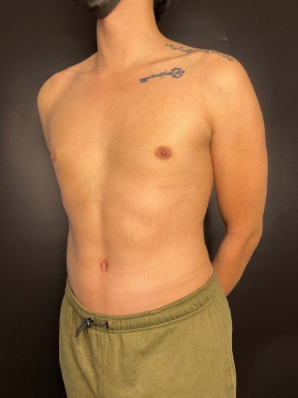 Liposuction Before & After Patient #4721