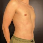 Liposuction Before & After Patient #4721