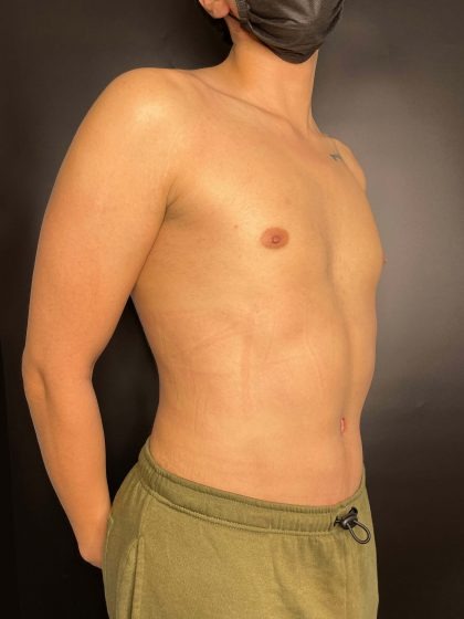 Liposuction Before & After Patient #4721