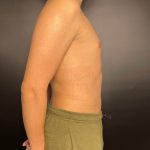 Liposuction Before & After Patient #4721