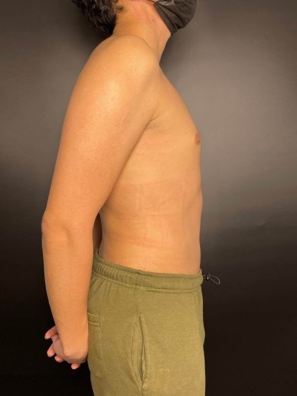 Liposuction Before & After Patient #4721