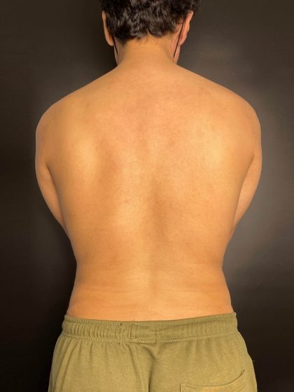 Liposuction Before & After Patient #4721
