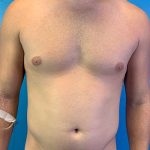 Liposuction Before & After Patient #4720