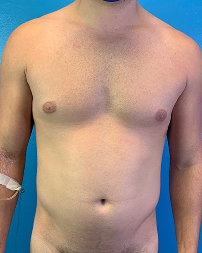 Liposuction Before & After Patient #4720