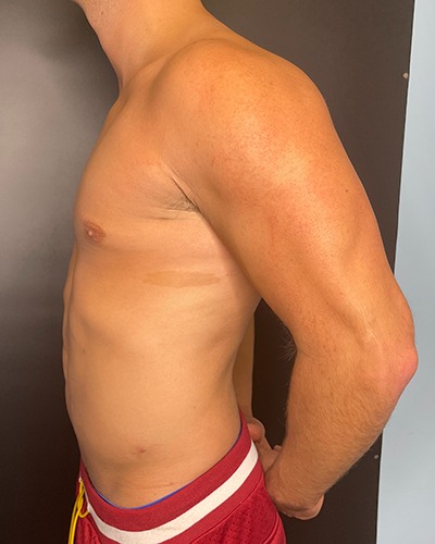 Liposuction Before & After Patient #4720