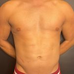 Liposuction Before & After Patient #4720