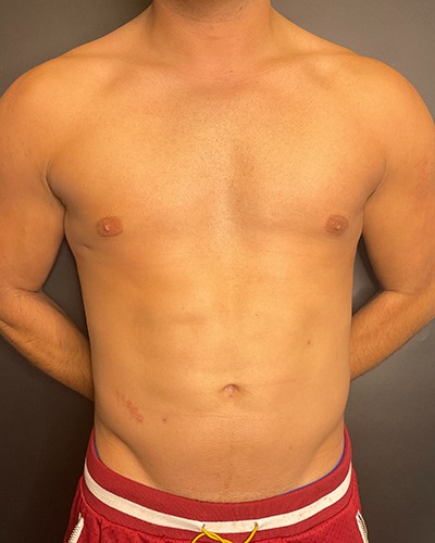 Liposuction Before & After Patient #4720