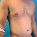 Liposuction Before & After Patient #4720