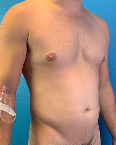 Liposuction Before & After Patient #4720