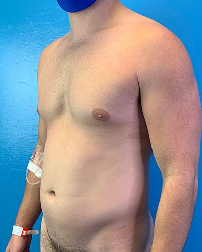 Liposuction Before & After Patient #4720