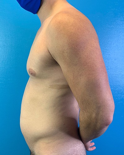 Liposuction Before & After Patient #4720