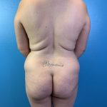 Brazilian Butt Lift Before & After Patient #4641