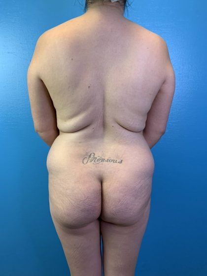 Brazilian Butt Lift Before & After Patient #4641