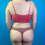 Brazilian Butt Lift Before & After Patient #4641