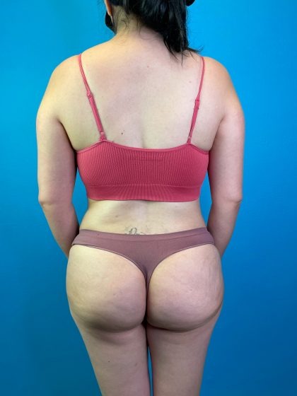 Brazilian Butt Lift Before & After Patient #4641