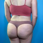 Brazilian Butt Lift Before & After Patient #4641