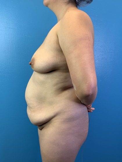 Brazilian Butt Lift Before & After Patient #4641
