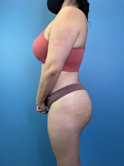 Brazilian Butt Lift Before & After Patient #4641