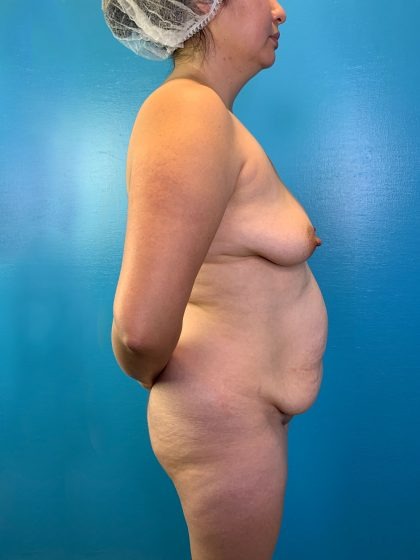 Brazilian Butt Lift Before & After Patient #4641