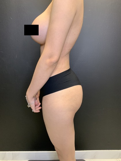 Brazilian Butt Lift Before & After Patient #4643