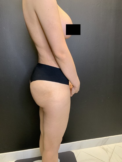 Brazilian Butt Lift Before & After Patient #4643