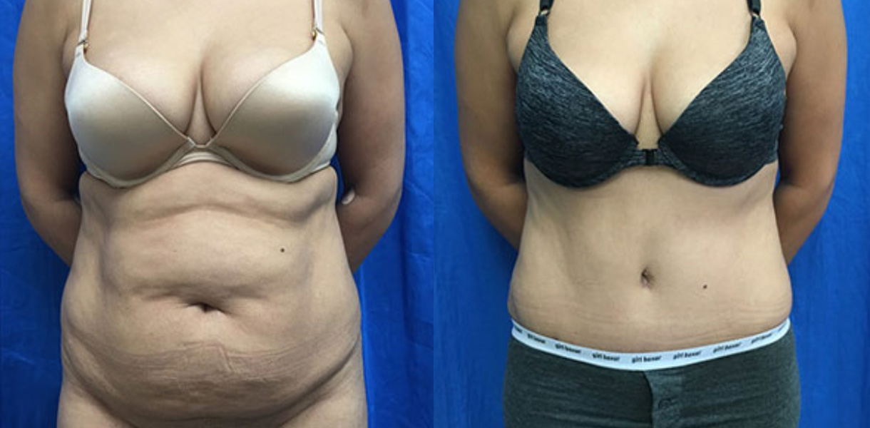 before and after picture