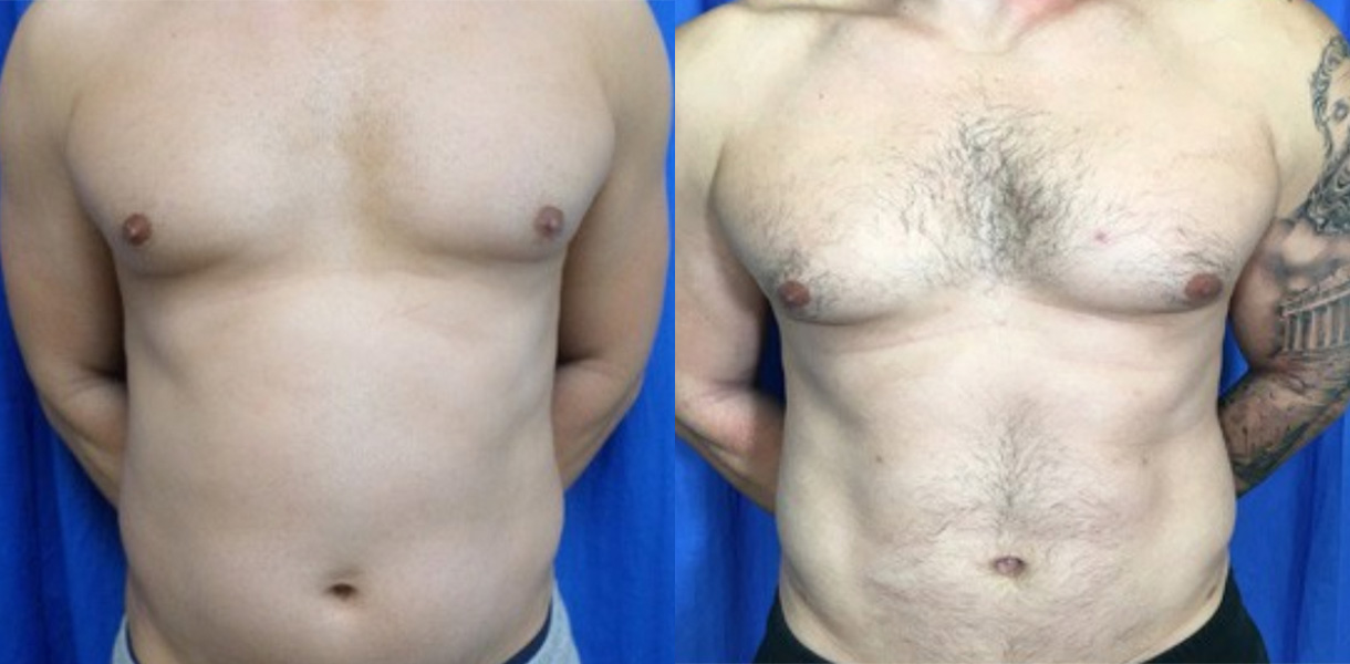 before and after picture